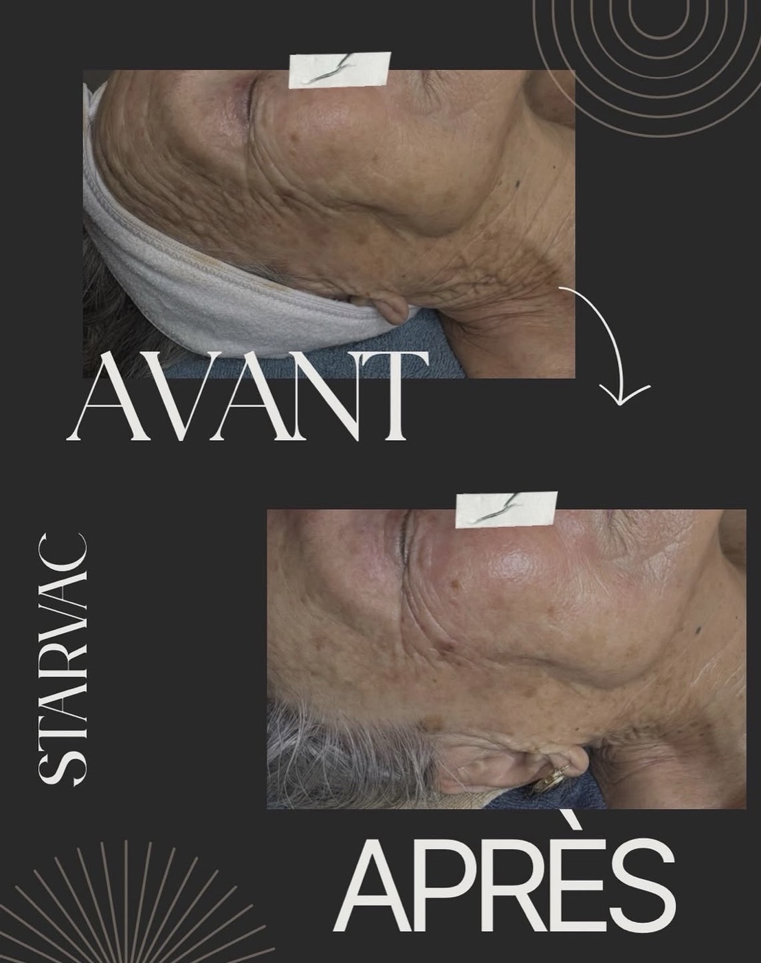 Avant après, Star Vac